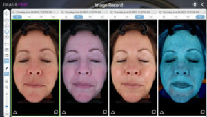 ImagePro SUNLITE 3d skin analysis